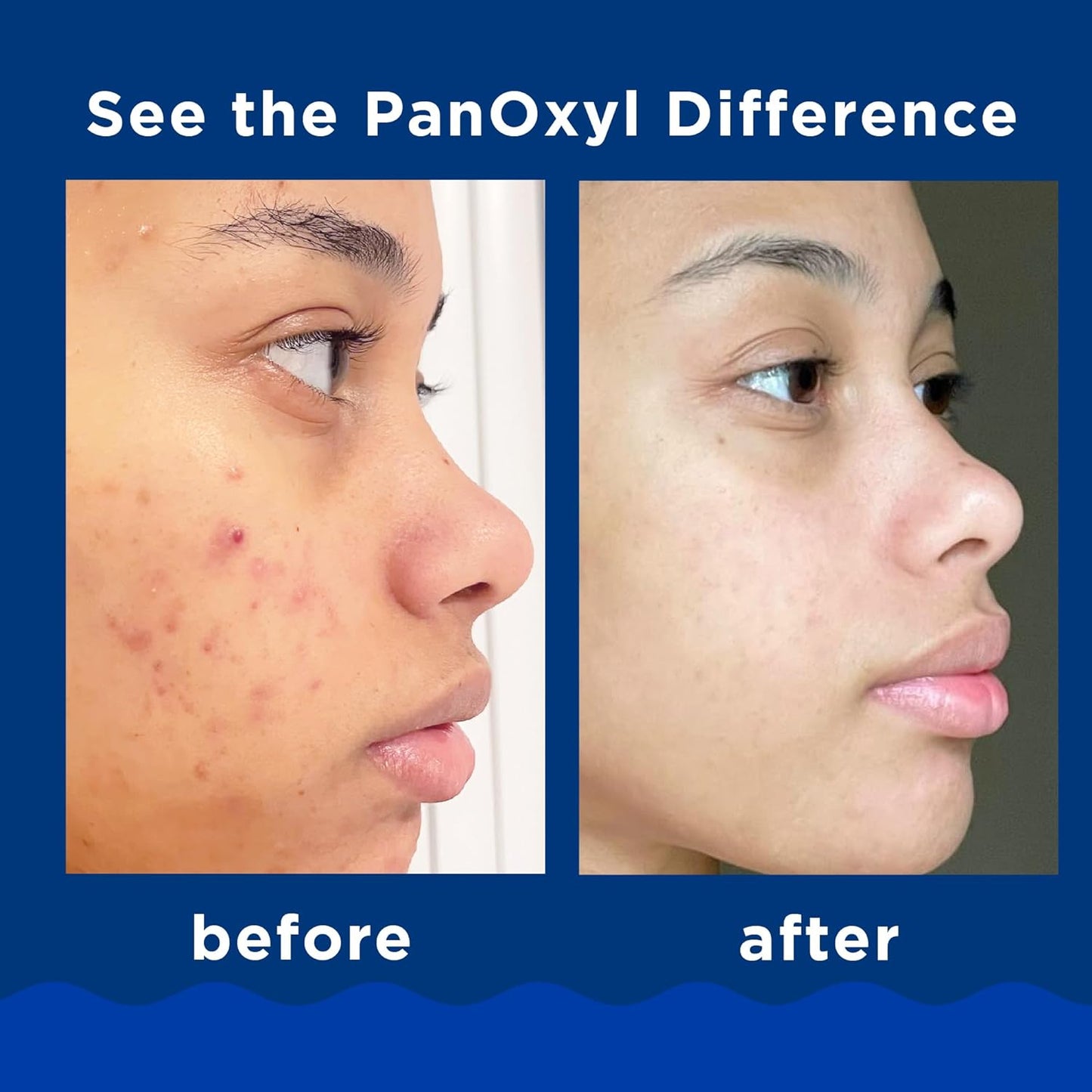 PanOxyl